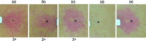 scratch test histamine|histamine prick test.